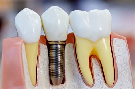 Dental implants.